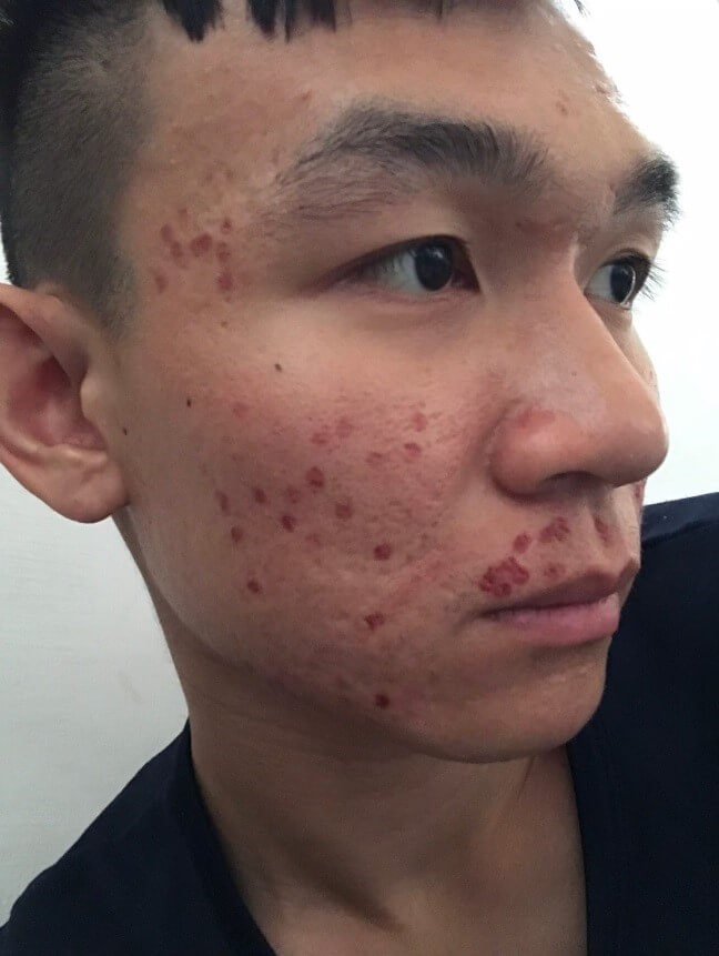 皮秒雷射告別滿臉豆花 終結惱人凹痘疤
