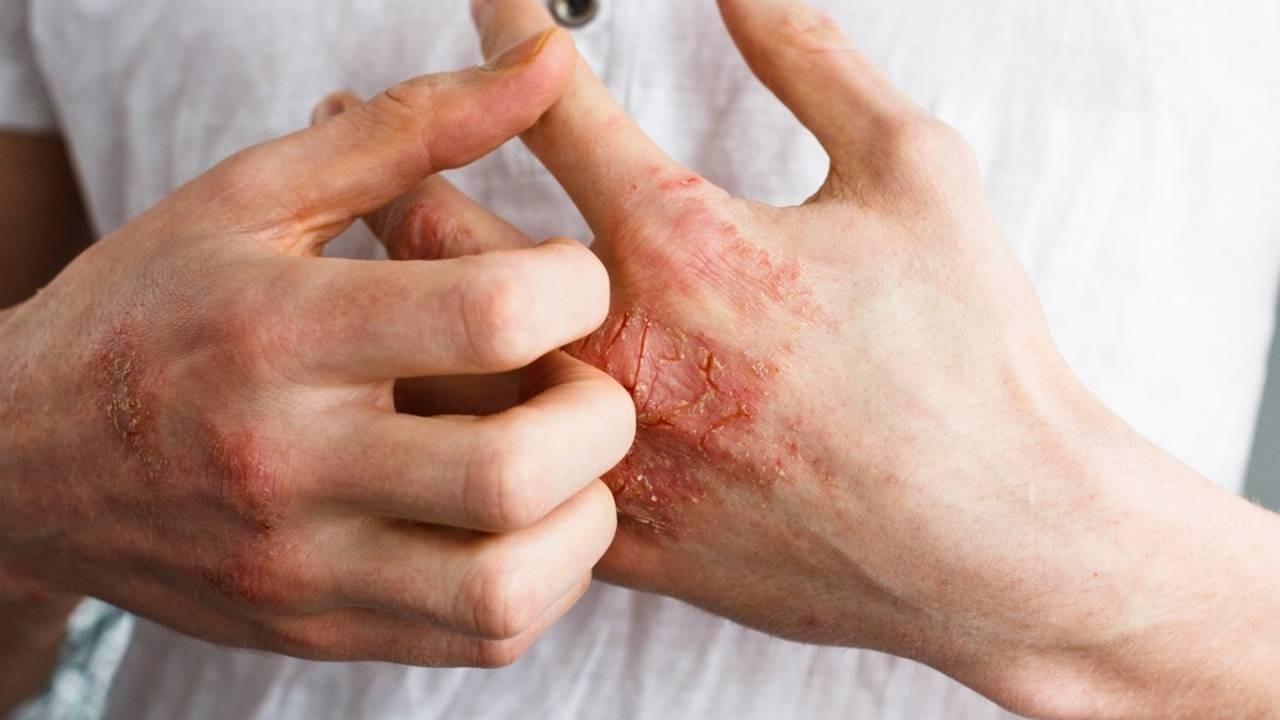 Hormone imbalances from stress & poor sleep can cause itchy skin.