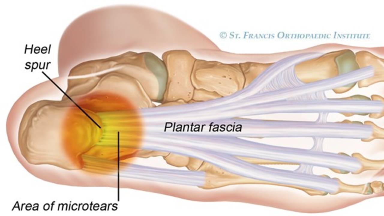 Why does your heel hurt? 2 factors that cause Plantar Fasciitis.