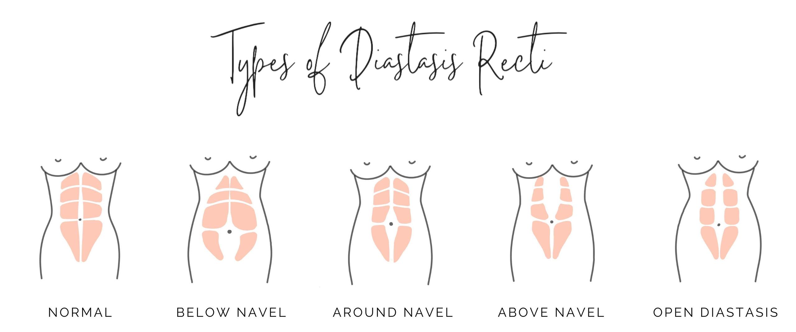 Types of diastasis recti