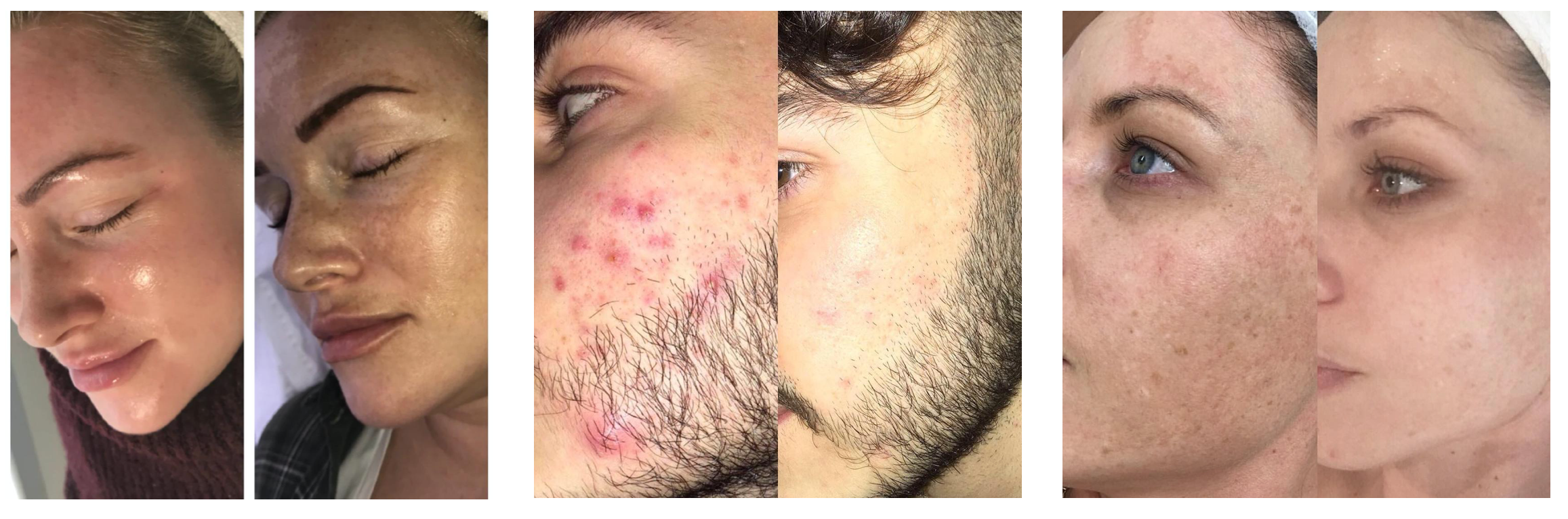 facial results