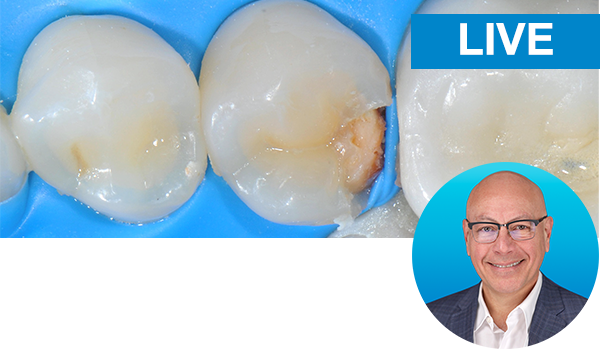 Bulk Fill Posterior Resin Composite Restorations Made Easy