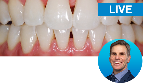 The direct-indirect composite resin veneer