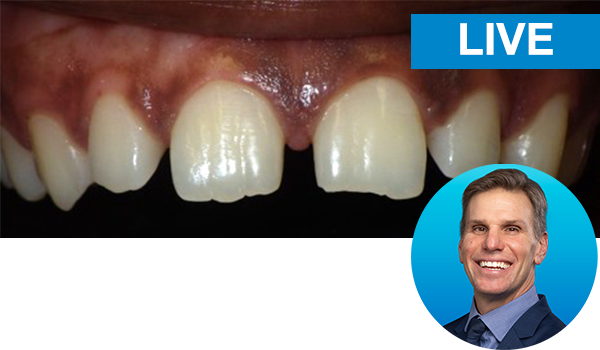 Predictable Diastema Closures Using the Bioclear Method Guest Instructor: Dr. Taras Konanec Injection molding warmed composite resin allows us to create monolithic restorations directly in the mouth. This technique of composite placement eradicates the issues of layering and hand manipulation that result in the formation of seams and voids. Participants will learn how the 3-step injection molding process can provide a predictable system for solving anterior esthetic dilemmas such as the closure of an anterior diastema. Pairing the anatomical Bioclear matrix with the “Rock Star Polish” allows the clinician to perform conservative, additive only dentistry resulting in strength, durability and esthetics. 1 HOUR | 1 CE CREDIT