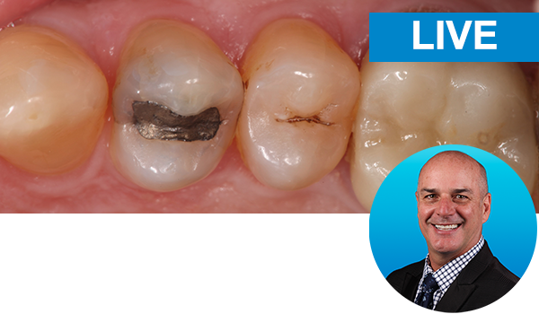 Mastering the Class II restorations with Dr. Marc Geissberger: Live