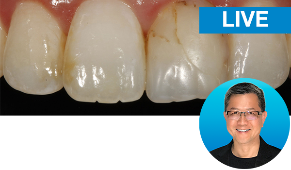 Simple concepts to shape and polish anterior composites to rival porcelain with Dr. David Chan: live