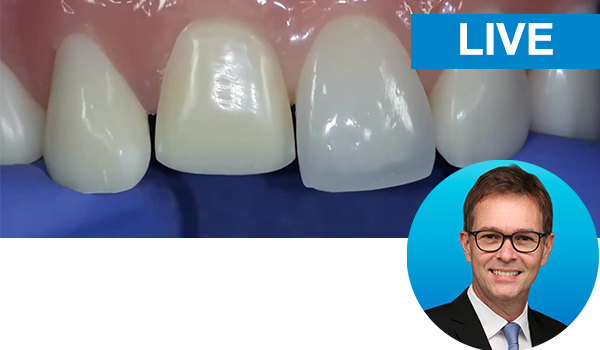 The direct-indirect composite resin veneer