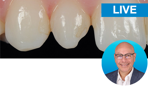 Esthetic Peg Lateral and Class II Direct restorations with Dr. Marcos Vargas: Live