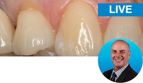 Beautiful Class V Restorations: Predictable and Modified