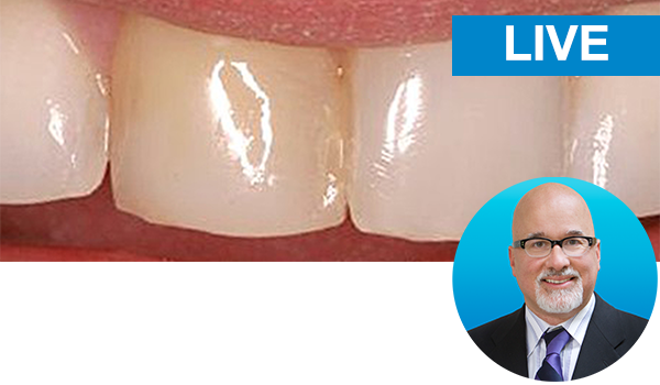 Restoring the Discolored Central Incisor Instructor: Dr. Bob Margeas