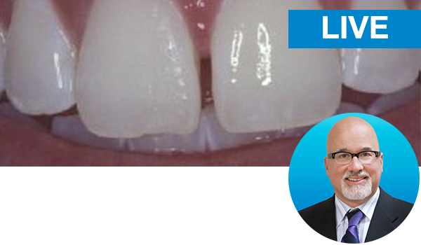 Dr. David Chan: Simple Concepts to Shape and Polish Anterior Composites