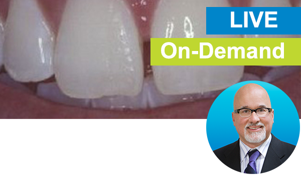 Freehand Diastema Closure: Live with Dr. Bob Margeas