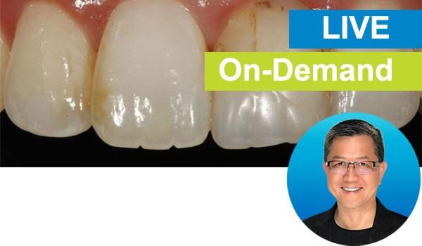 Simple Concepts to Shape and Polish Anterior Composites to Rival Porcelain: Live with Dr. David K. Chan