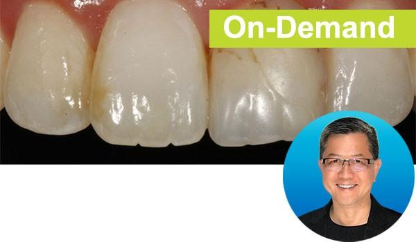 Simple Concepts to Shape & Polish Anterior Composites to Rival Porcelain Instructor: Dr. David Chan