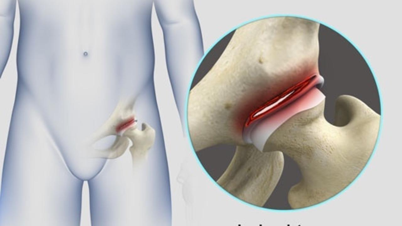 hip labral tear