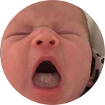 Breastfeeding Tongue Tie Thompson Method
