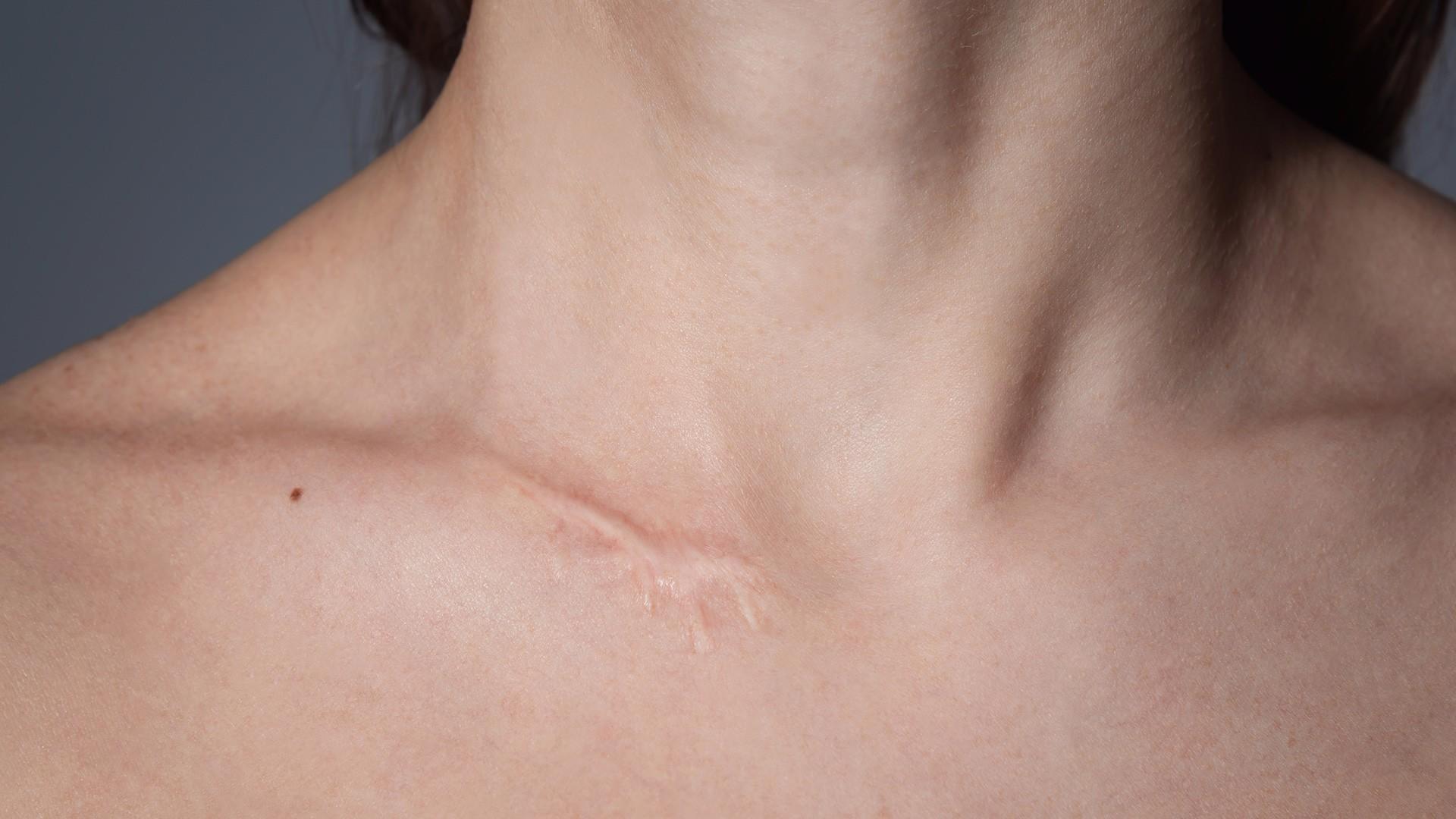 woman with a scar on her collarbone - Scar Tissue Release Therapy is available at pureBalance Wellness in Mississauga