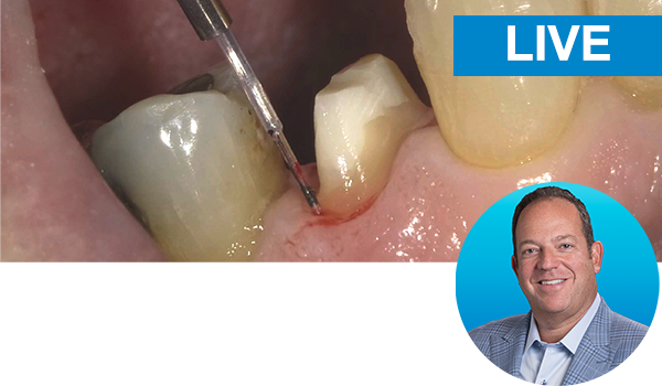 Bulk fill posterior resin composite restorations made easy with Dr. Vargas