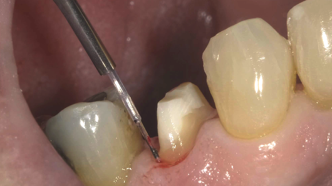 Teach Me to Be a Laser Dentist - A Crash Course on Diode Lasers and Restorative Dentistry With Dr Ron Kaminer-Live Demonstration Webinar